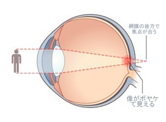 遠視カラコン